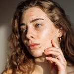 4 Tips to Find a Top Acne Specialist Near You