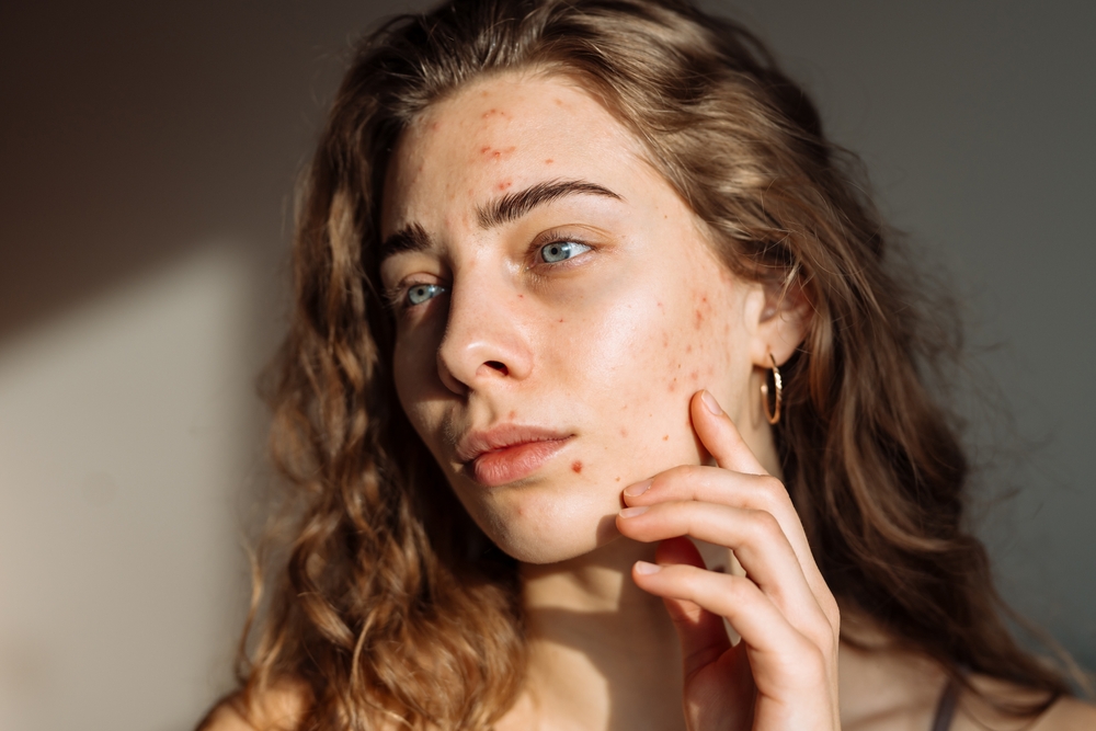 4 Tips to Find a Top Acne Specialist Near You