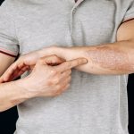 Best Psoriasis Specialist in Reno, Nevada: When to Schedule an Appointment (And How to Find the Right One!)