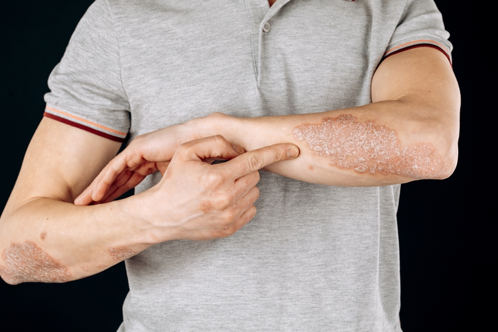 Best Psoriasis Specialist in Reno, Nevada: When to Schedule an Appointment (And How to Find the Right One!)
