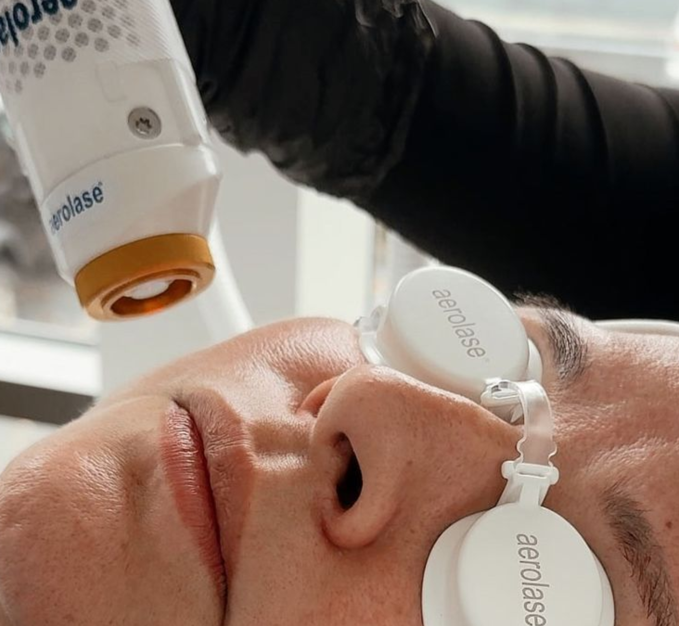 Aerolase Acne Treatment in Reno