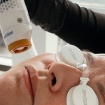 Aerolase Acne Treatment in Reno