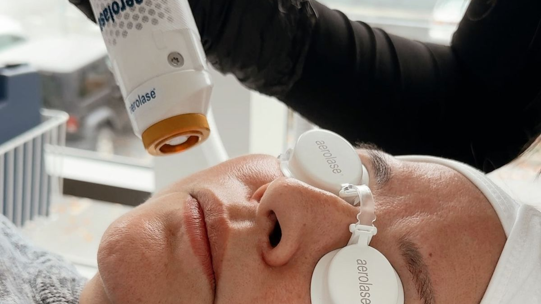Aerolase Acne Treatment in Reno