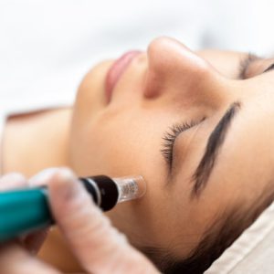 PRX with microneedling for skin texture and acne scars in Reno