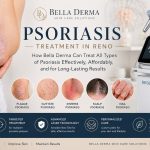 Psoriasis treatment Reno