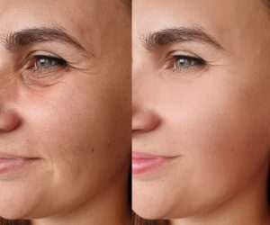 Skin texture improvement with PRX Derm Perfexion and microneedling