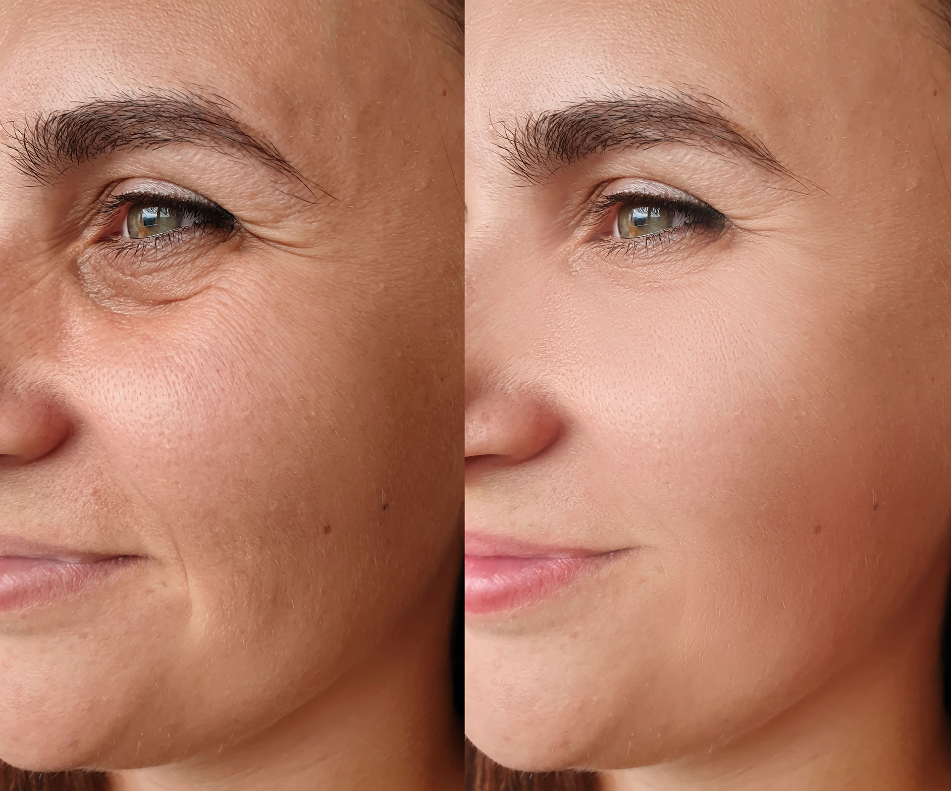 Skin texture improvement with PRX Derm Perfexion and microneedling