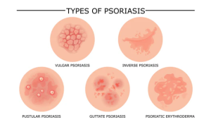 Different types of psoriasis explained for Reno patients