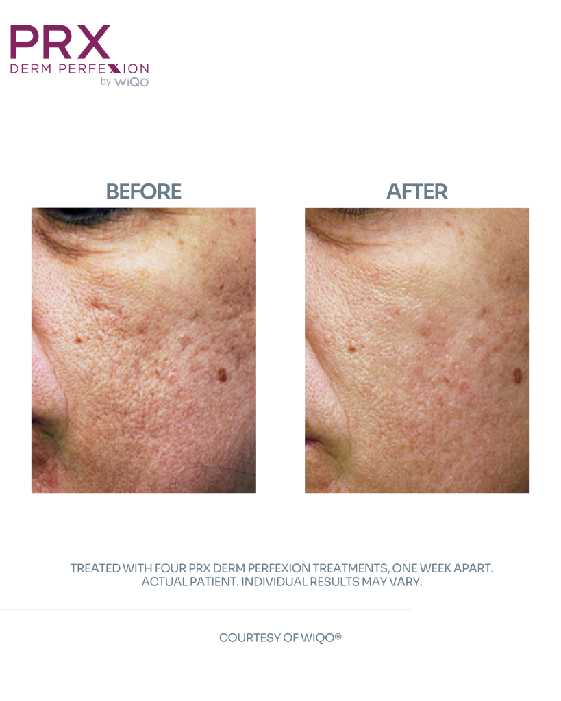 Actual patient before and after four PRX Derm Perfexion treatments