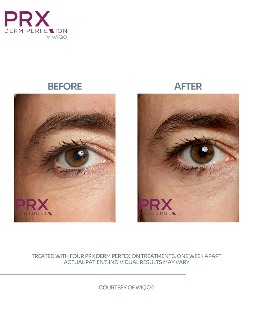 Actual patient before and after four PRX Derm Perfexion treatments