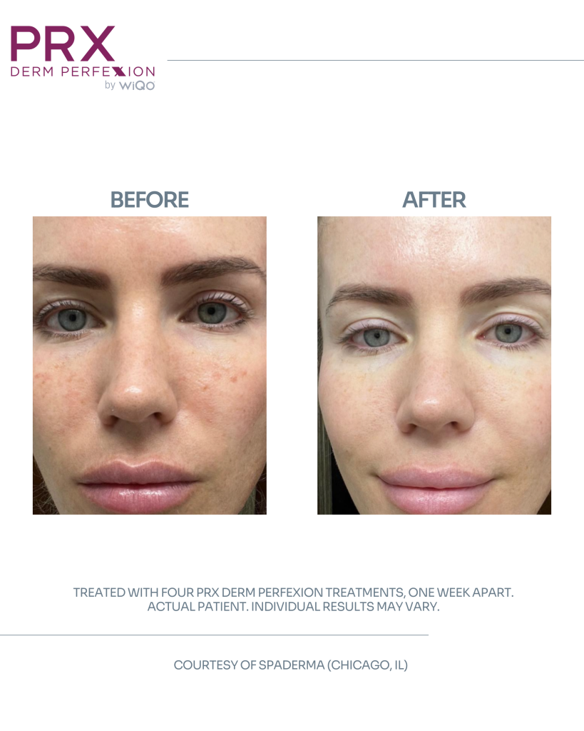 PRX Derm Perfexion before and after results for an actual patient