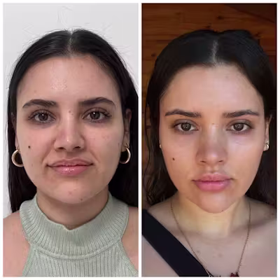 VAMP Advanced Microneedling before and after result with topical PDRN.