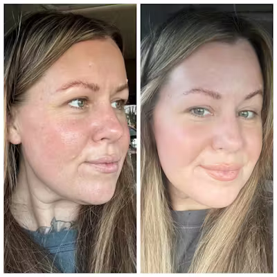 VAMP Advanced Microneedling before and after result.
