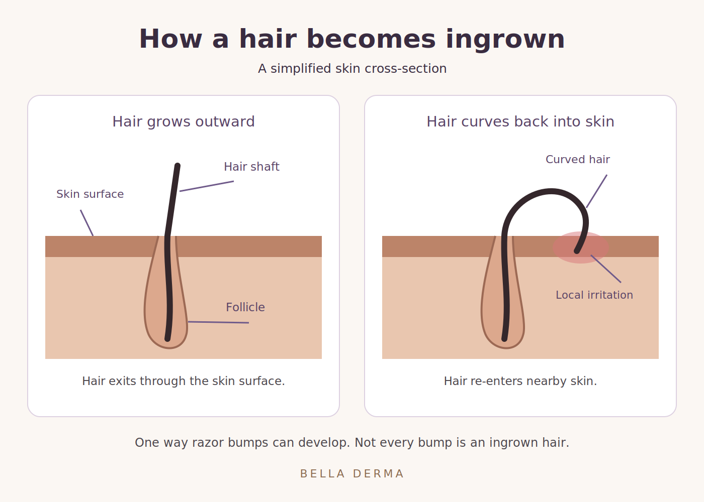 Ingrown hairs and razor bumps: simplified skin cross-sections showing a hair growing outward and a curved hair re-entering nearby skin with local irritation.