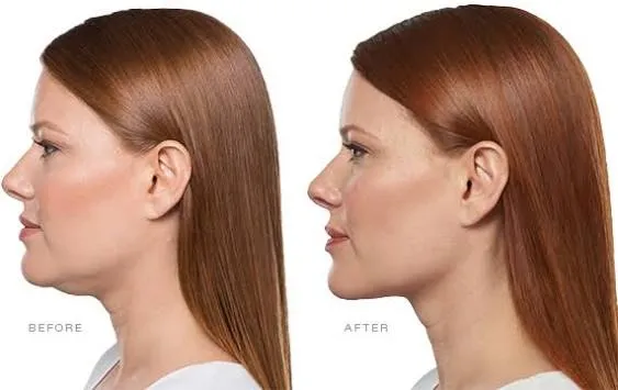 Kybella in Reno before and after result for submental fullness beneath the chin